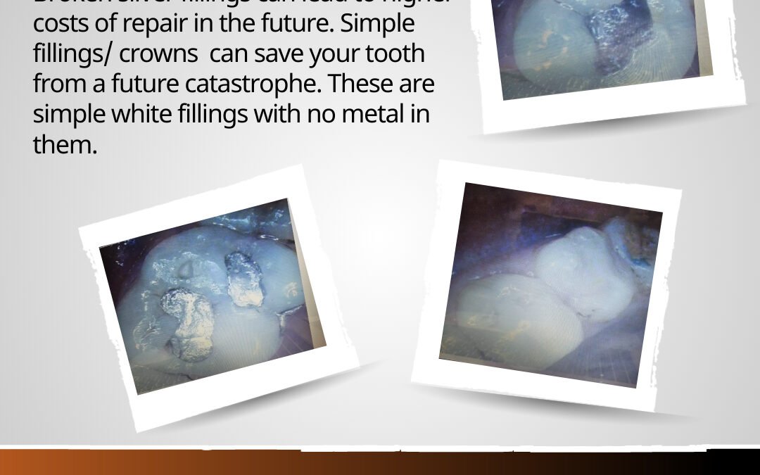 Broken Silver Fillings