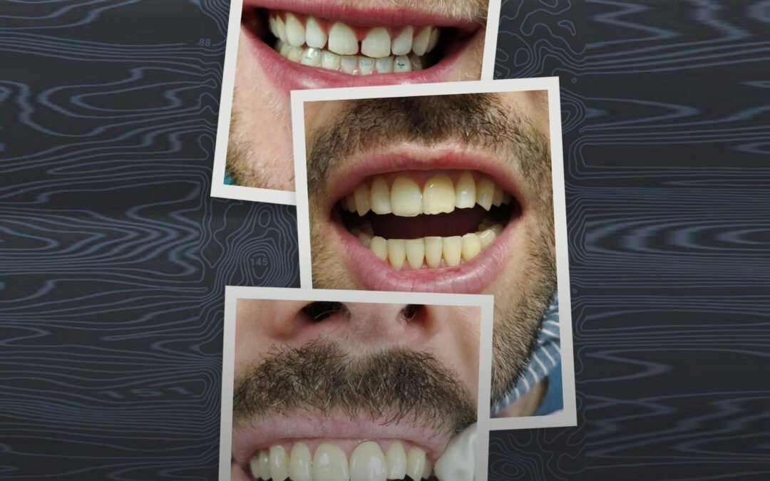 Retainers after the Case