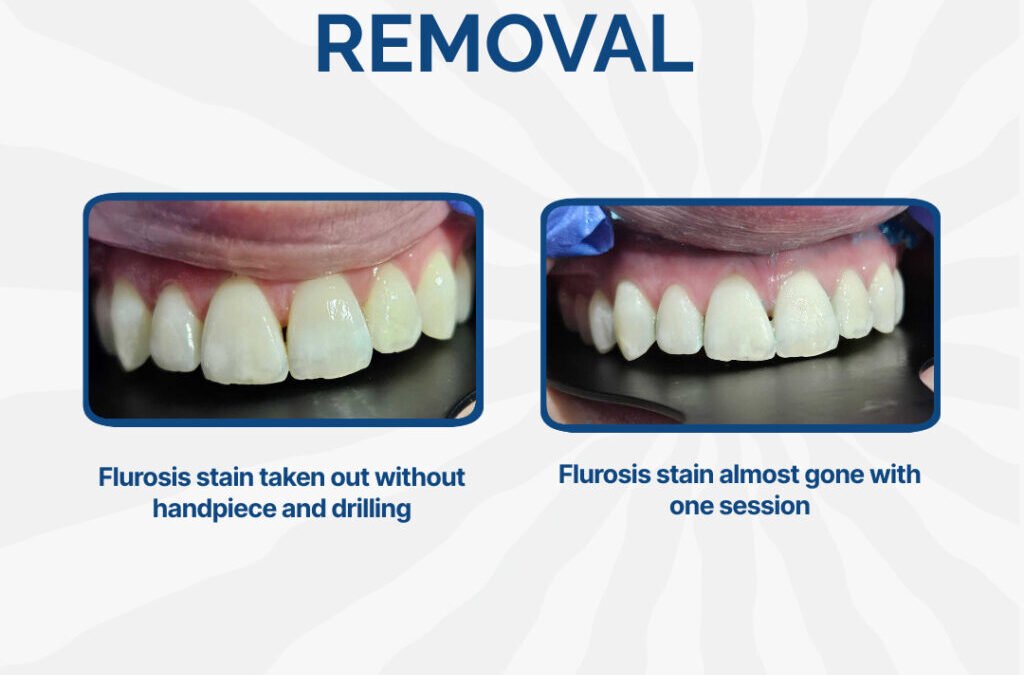 Flurosis Strain Removal