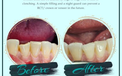 Broken Teeth Filling