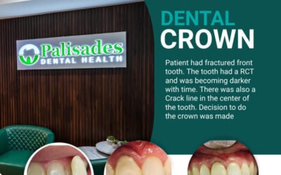 DENTAL CROWN