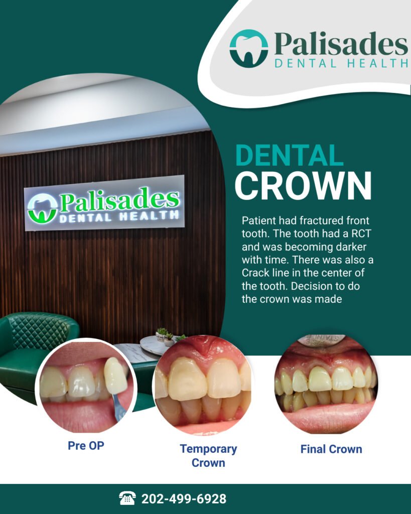 DENTAL CROWN