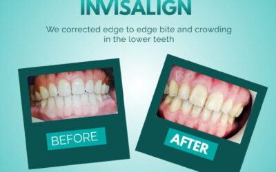 Invisalign