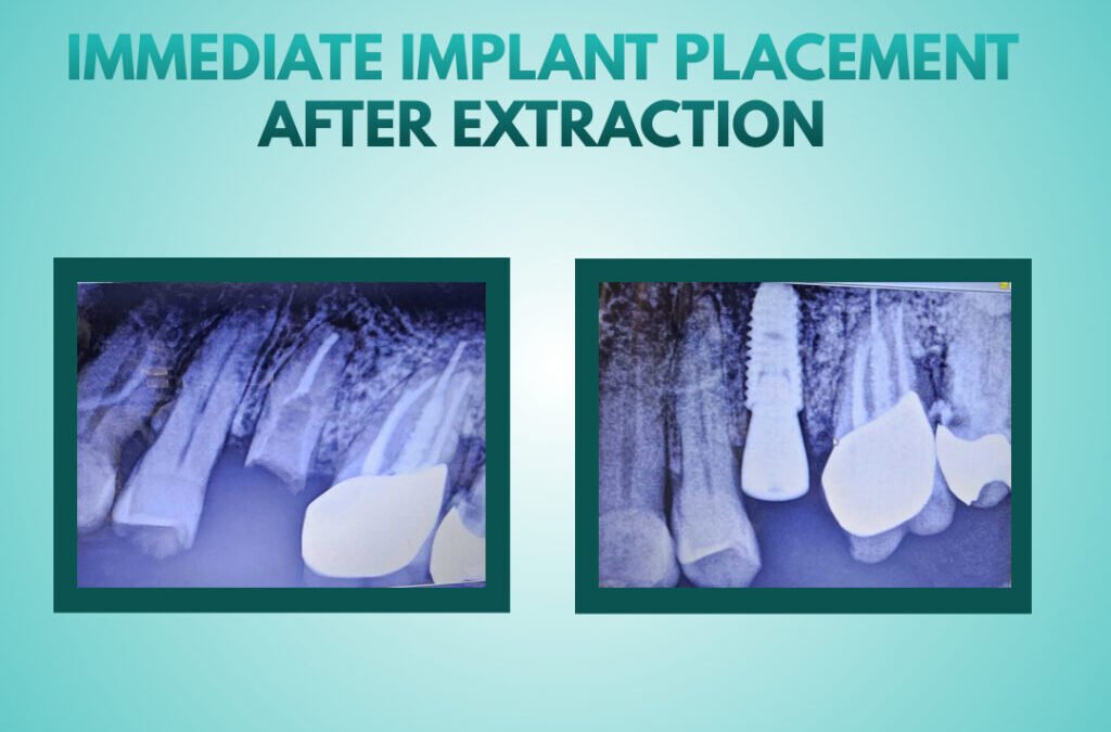 Immediate Implant Placement After Extraction