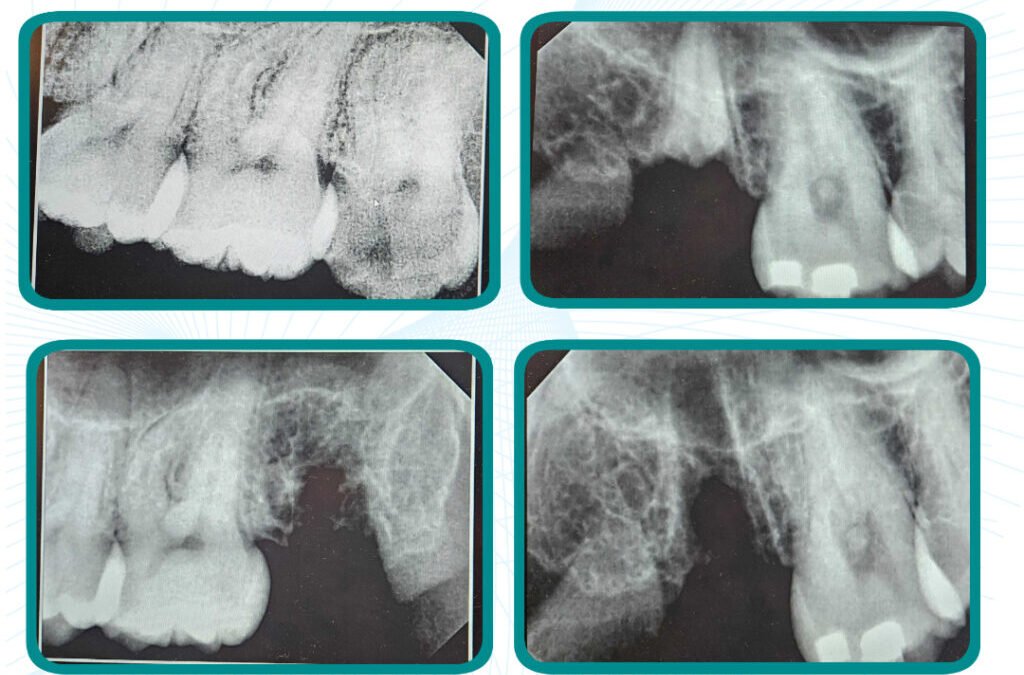 Painless Wisdom Teeth Removal