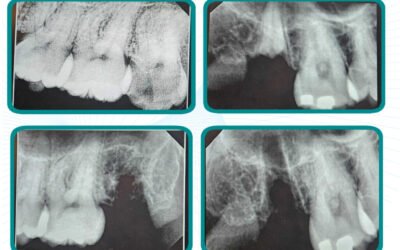 Painless Wisdom Teeth Removal at Palisades Dental Health in Washington D.C.