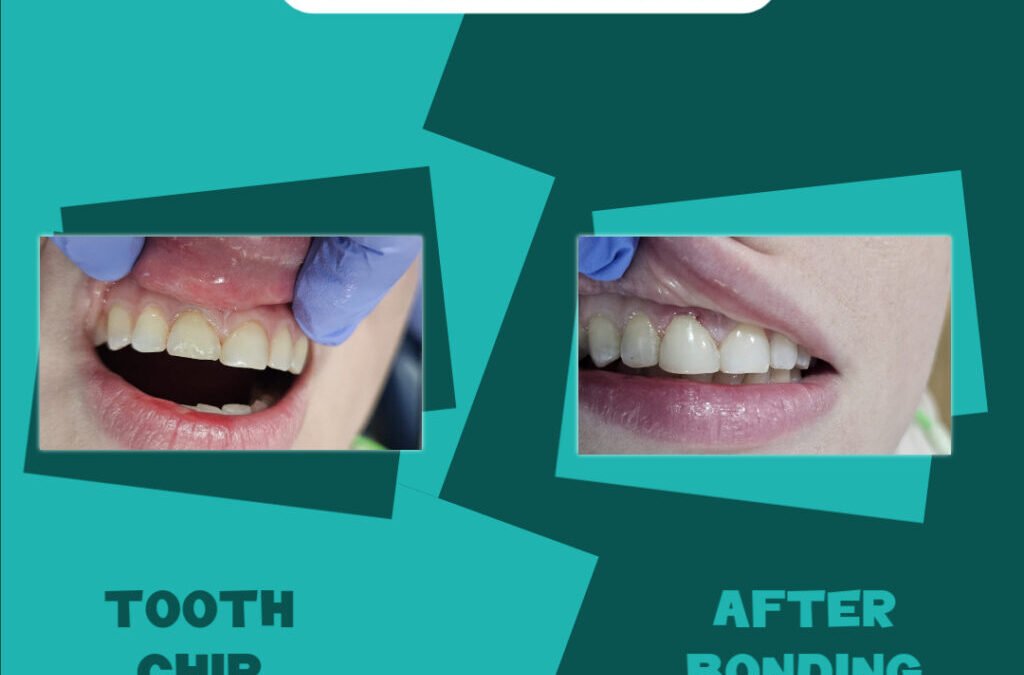 Tooth Bonding