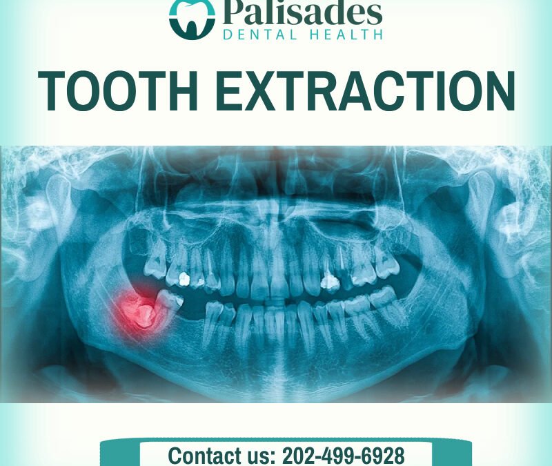 Tooth Extraction