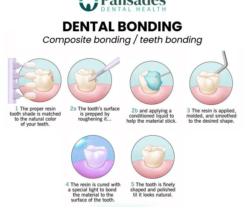 Dental Bonding
