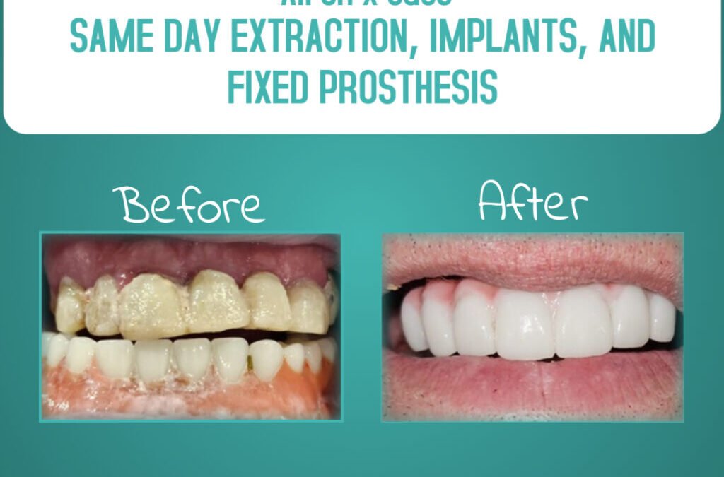 Same Day Extraction