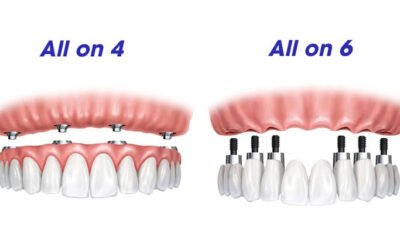 What Are All-on-4 Dental Implants?