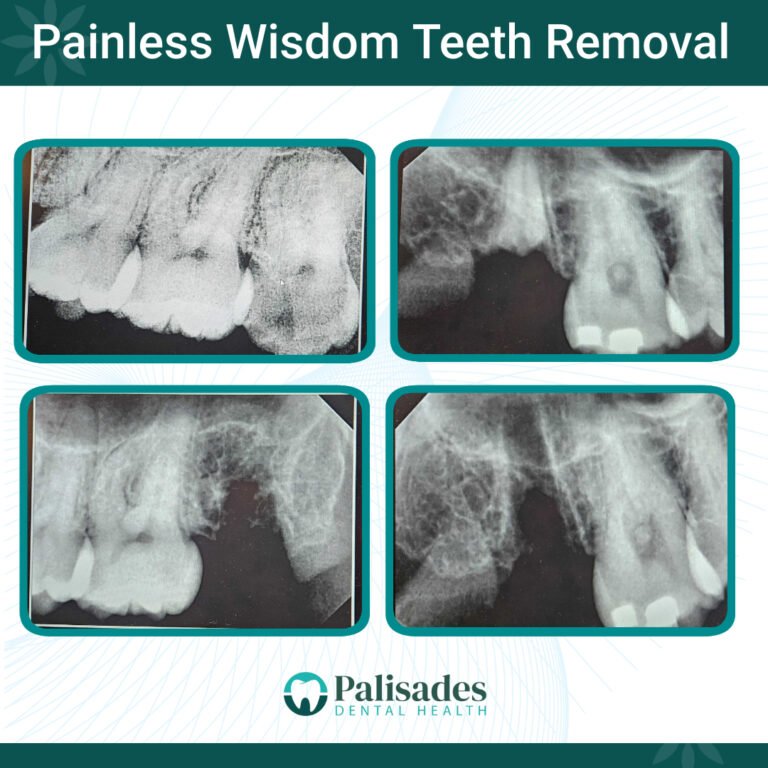 Painless Wisdom Teeth Removal at Palisades Dental Health in Washington D.C.