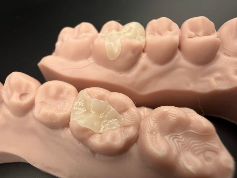 e.max® and ceramic onlays