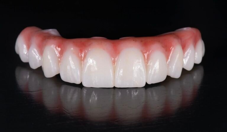 What Are All-on-4 Dental Implants?